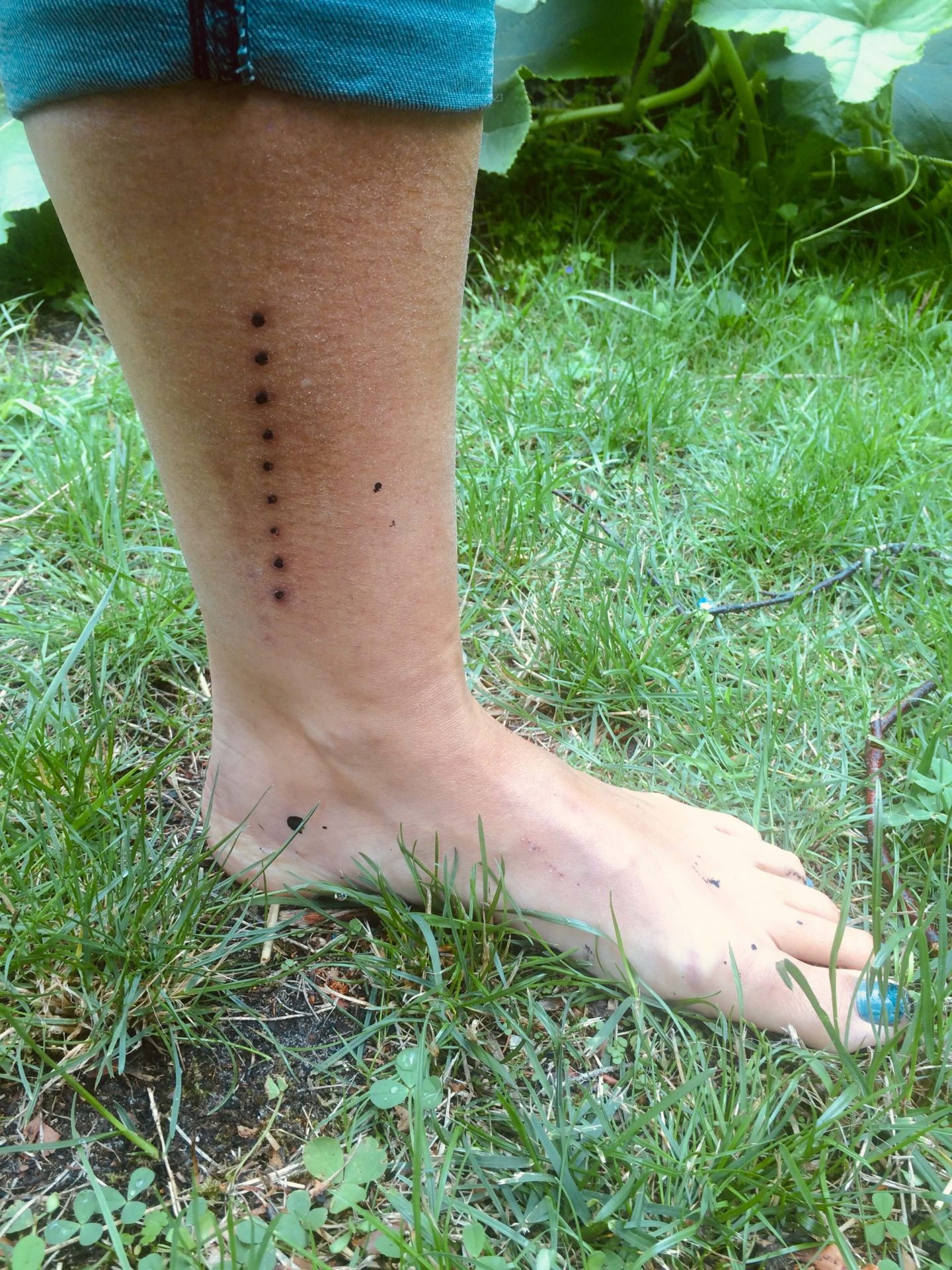 Anja Dalbys ben med 9 små, runde brændemærker efter kambo.